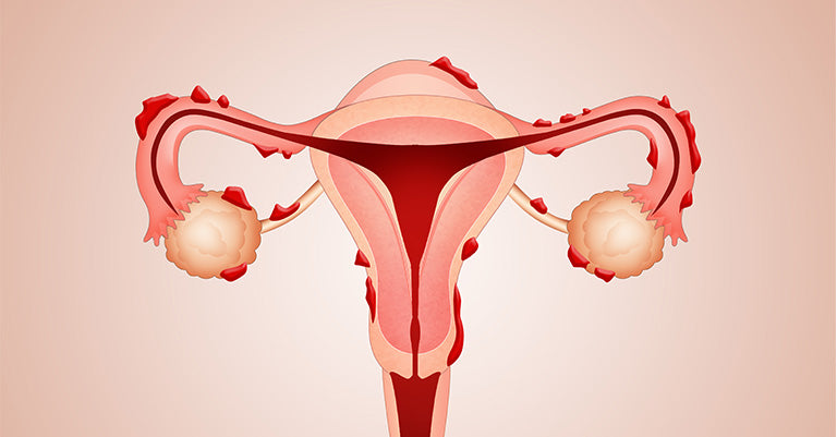 Douleurs menstruelles et endométriose : des solutions prometteuses grâce au CBD