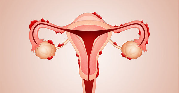 Douleurs menstruelles et endométriose : des solutions prometteuses grâce au CBD